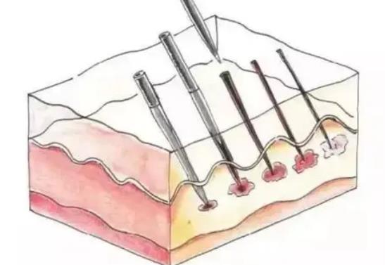 微針和水光補(bǔ)水有什么不同?千萬(wàn)別選錯(cuò)!