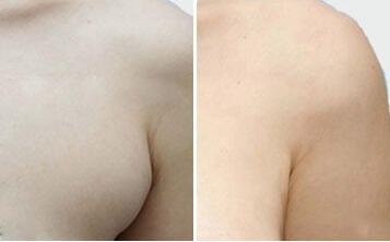 副乳切除術(shù)后的護理要點，多久可以抬手臂?