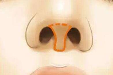 哪些鼻小柱畸形需要手術(shù)矯正，快看看你是不是