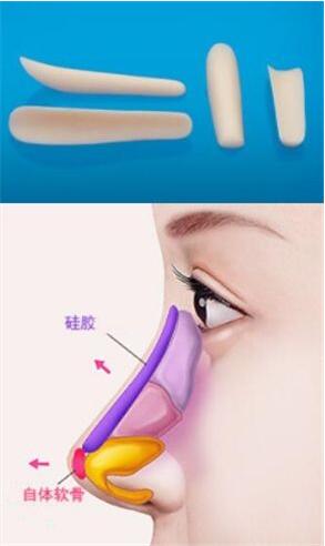 隆鼻假體取出后有后遺癥嗎?假體取出后鼻子會更塌嗎?