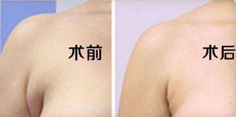 哪些習(xí)慣容易形成副乳?跟內(nèi)衣穿戴有關(guān)嗎?