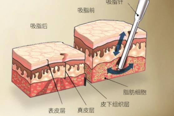 水動(dòng)力吸脂對(duì)身體有沒有影響呢?真相在這里!!！