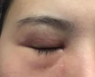 雙眼皮出現(xiàn)疤痕增生怎么辦？解決方法都在這里啦~