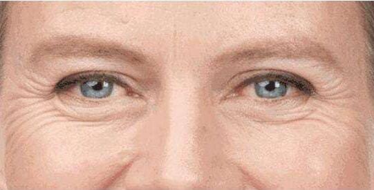 如何去除魚尾紋?去除魚尾紋的方法有哪些?