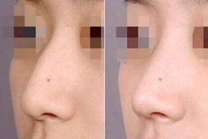 所有的駝峰鼻都需要磨骨矯正嗎?