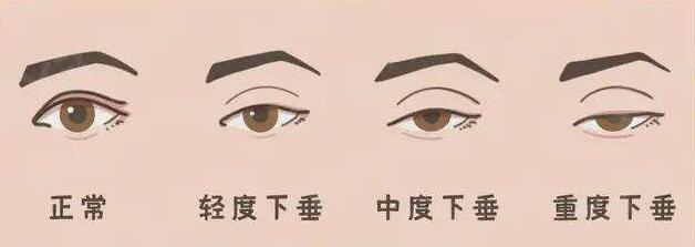 怎么判斷自己有上瞼下垂？如何預防？