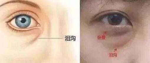 填充淚溝的方法有哪些