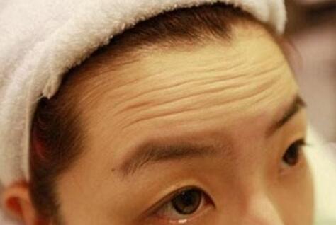 注射瘦臉和玻尿酸去抬頭紋哪個(gè)好