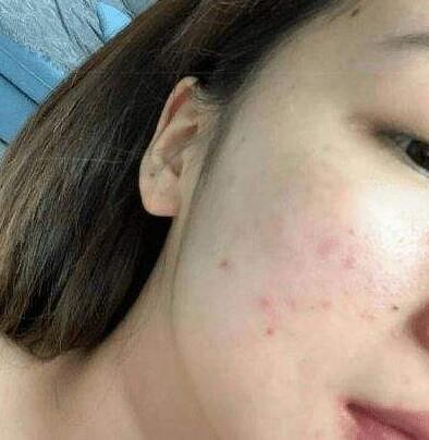 激光去痘印的間隔時間，以及恢復(fù)過程