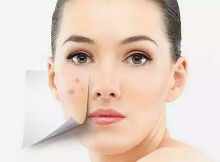 激光去痘印只做一次能夠見嗎?