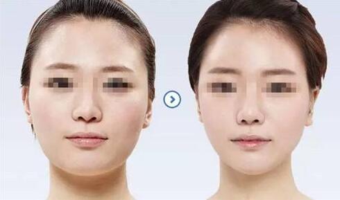 注射瘦臉能持續(xù)多久