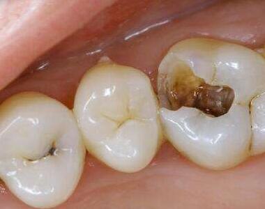 補牙洞是否需要打麻藥呢