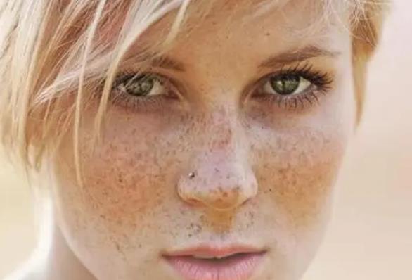 臉上斑點(diǎn)越來(lái)越多應(yīng)該怎么辦？原來(lái)是這有問(wèn)題了!