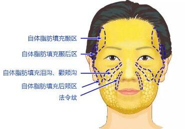 自體脂肪填充之后能吃什么食物?