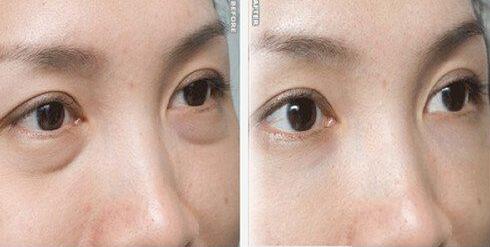 做眼袋手術是否存在風險?