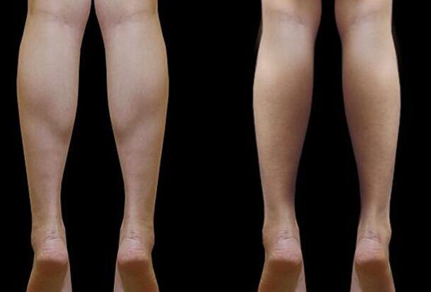 注射注射瘦腿有副作用嗎，會反彈嗎?