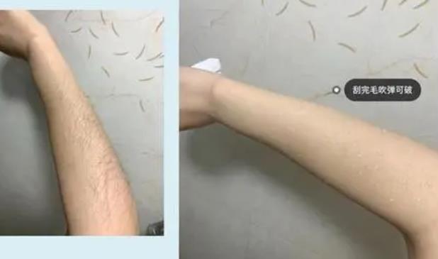 超冰脫毛和冰點(diǎn)脫毛有什么區(qū)別?