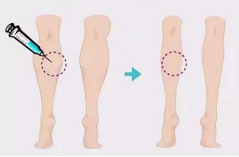 注射注射瘦腿之后可以跑步嗎