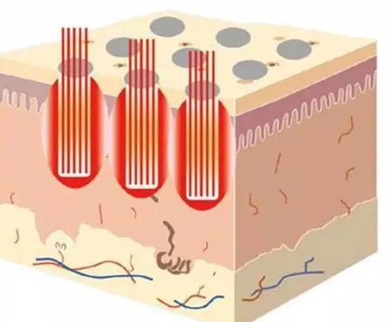 點(diǎn)陣激光副作用、風(fēng)險是什么?