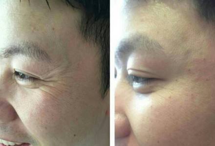 注射瘦臉毒素除皺真的有嗎?有皺紋怎么辦?
