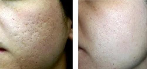 點(diǎn)陣激光的優(yōu)點(diǎn)是什么，如何保養(yǎng)？