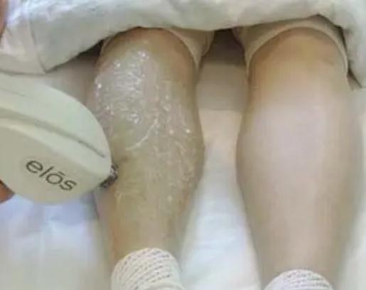 光子脫毛方法的原理是什么?還會(huì)在長(zhǎng)嗎?