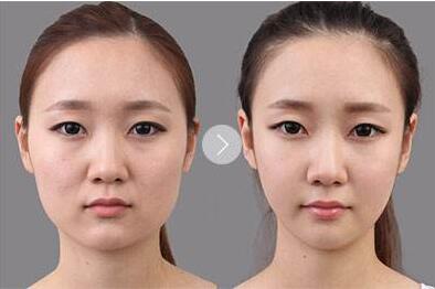 打注射瘦臉臉部會有凹陷嗎