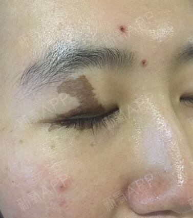 激光去除胎記后需要多久恢復(fù)