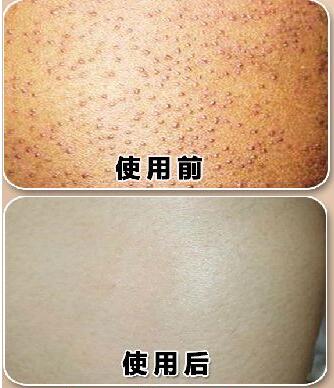 激光能去雞皮嗎?哪些方法去除雞皮有?