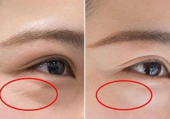 切眉能不能去掉魚尾紋