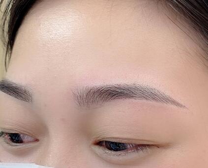 切眉術(shù)后如何護(hù)理?有哪些飲食禁忌?