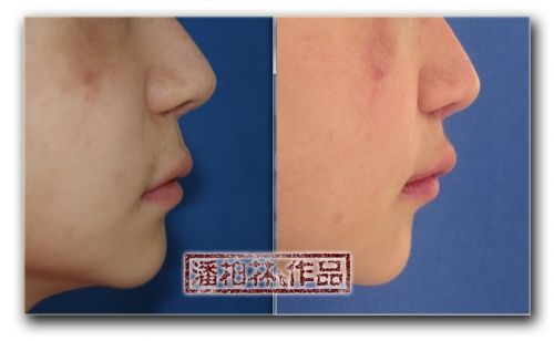 上唇過長怎么辦?如何改良上唇過長？