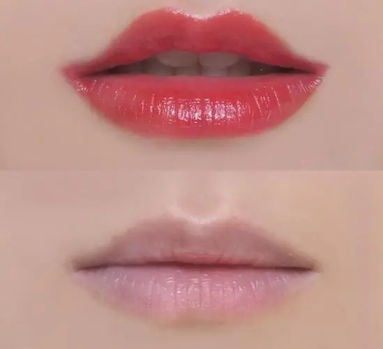 上嘴唇太長顯老怎么辦?