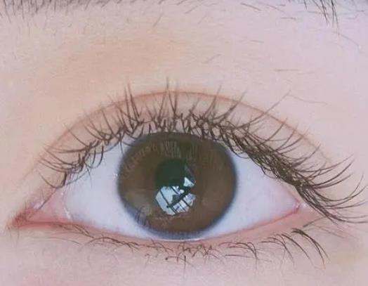 雙眼皮埋線和全切哪個好