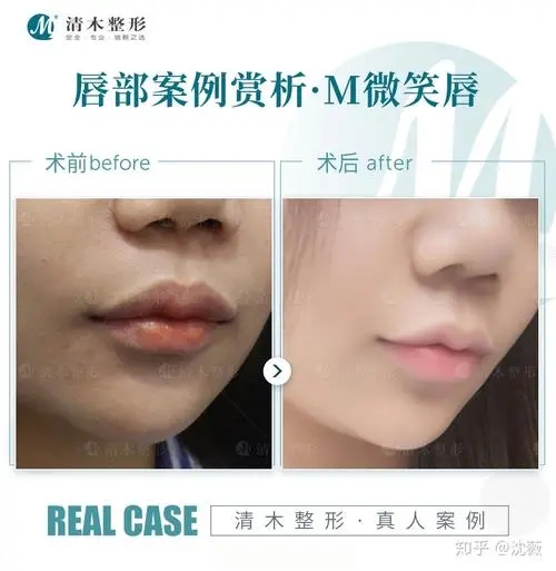 嘴唇厚嘴唇不好怎么辦?厚唇改薄會增生嗎?