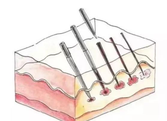 微針做一次的價格是多少?影響因素是什么