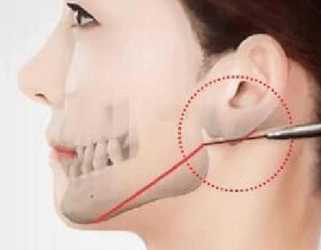 削顴骨能持續(xù)幾年