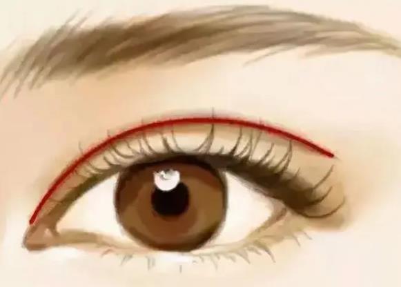 切開雙眼皮消腫大概需要多久