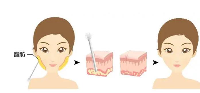 冷凍溶脂的價格是多少，冷凍溶脂有嗎