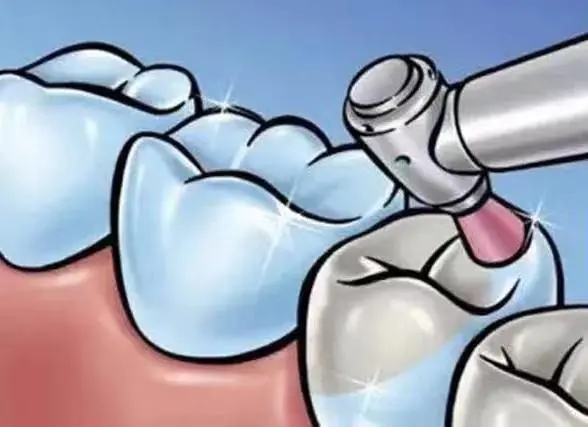 補牙材料會脫落的情況有哪些?補牙洞需要多久?