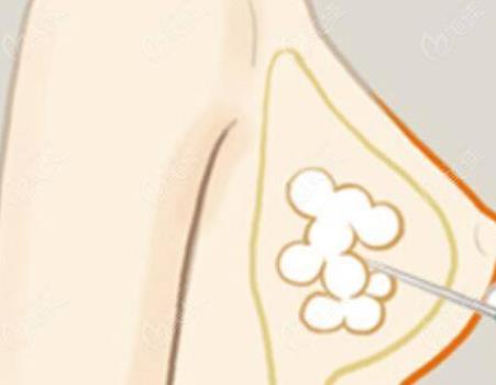 注射玻尿酸豐胸可以維持多久?