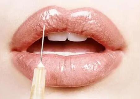 玻尿酸隆唇要注射多少玻尿酸