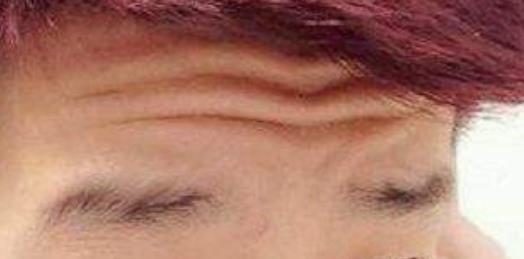 青少年額頭有抬頭紋的原因，應(yīng)該怎么辦