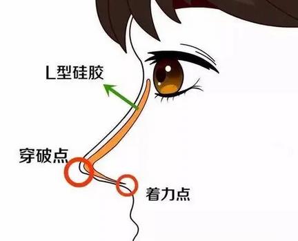 硅膠鼻子能撐多久?硅膠假體隆鼻需要多長(zhǎng)時(shí)間?