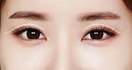 做一個全切雙眼皮要多少錢?全切雙眼皮的優(yōu)勢是什么?