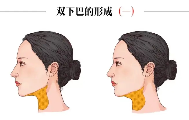 廣州雙下巴抽脂減肥價格?雙下巴吸脂術(shù)后的護理要注意什么?