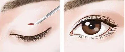 雙眼皮失敗的表現有哪些?雙眼皮修復高嗎?