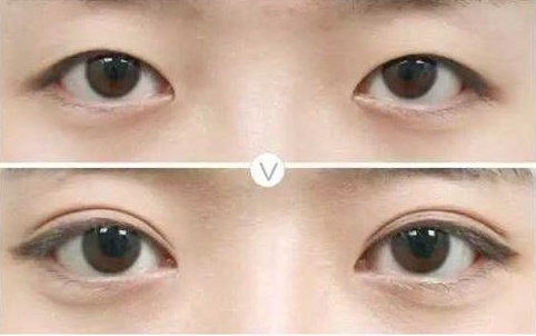 眼睛修復(fù)高嗎?上眼下垂怎么修復(fù)?