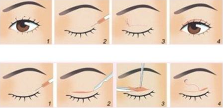 雙眼皮是埋線好還是全切好?手術維持時間的對比!