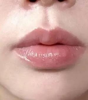 玻尿酸豐唇珠嗎